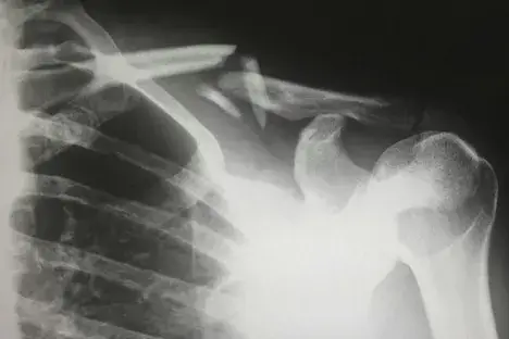 X-ray of worker who was injured on the job.