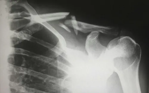 X-ray of worker who was injured on the job.